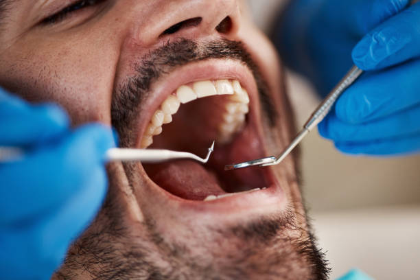 Best Emergency Dentist for Lost Fillings or Crowns in Somerset, MD