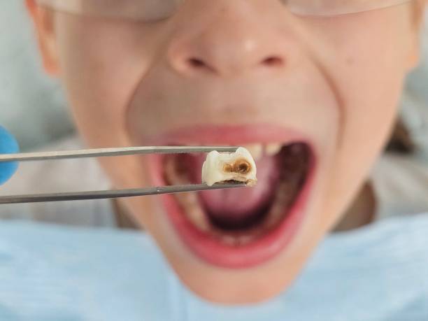 Best Emergency Dental Care for Abscessed Tooth in Somerset, MD